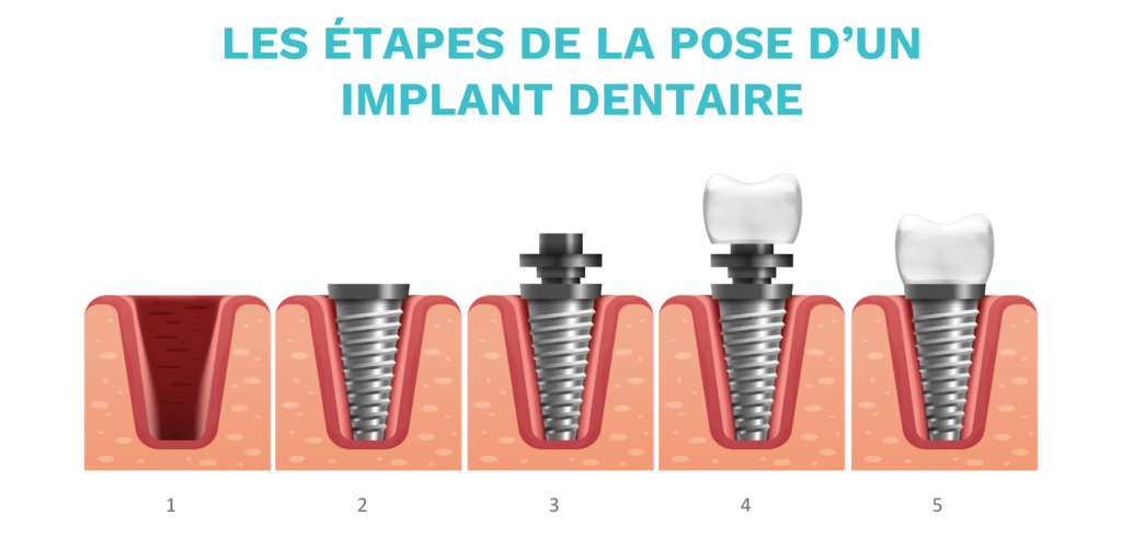 Schéma des 5 principales étapes de la pose d'un implant dentaire