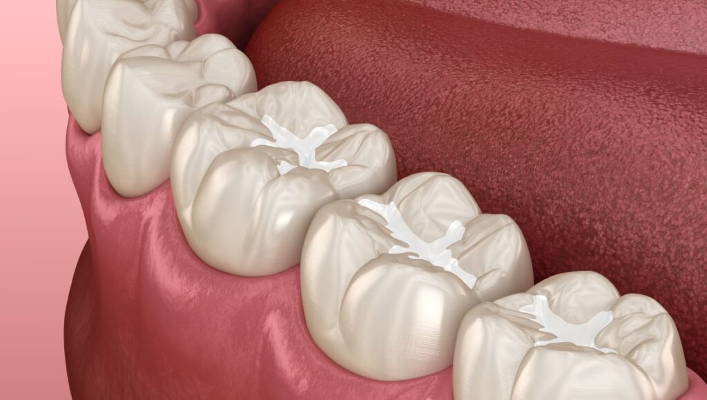 Un scellant dentaire est appliqué sur les molaires et les prémolaires