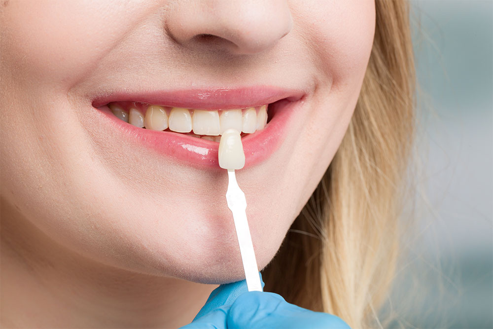 combien-temps-dure-les-facettes-dentaires