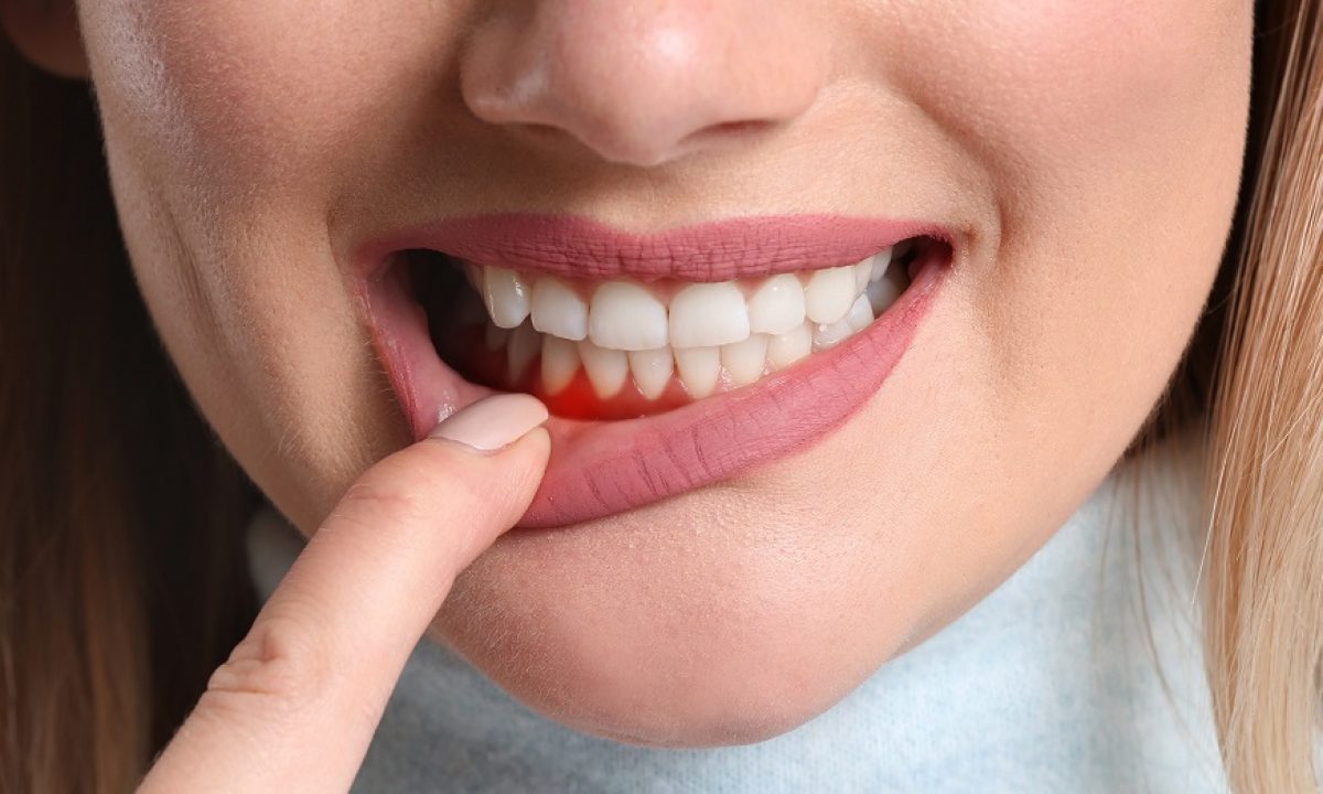 Surfaage Radiculaire ou Dtartrage Sous-Gingival : Quoi Savoir?