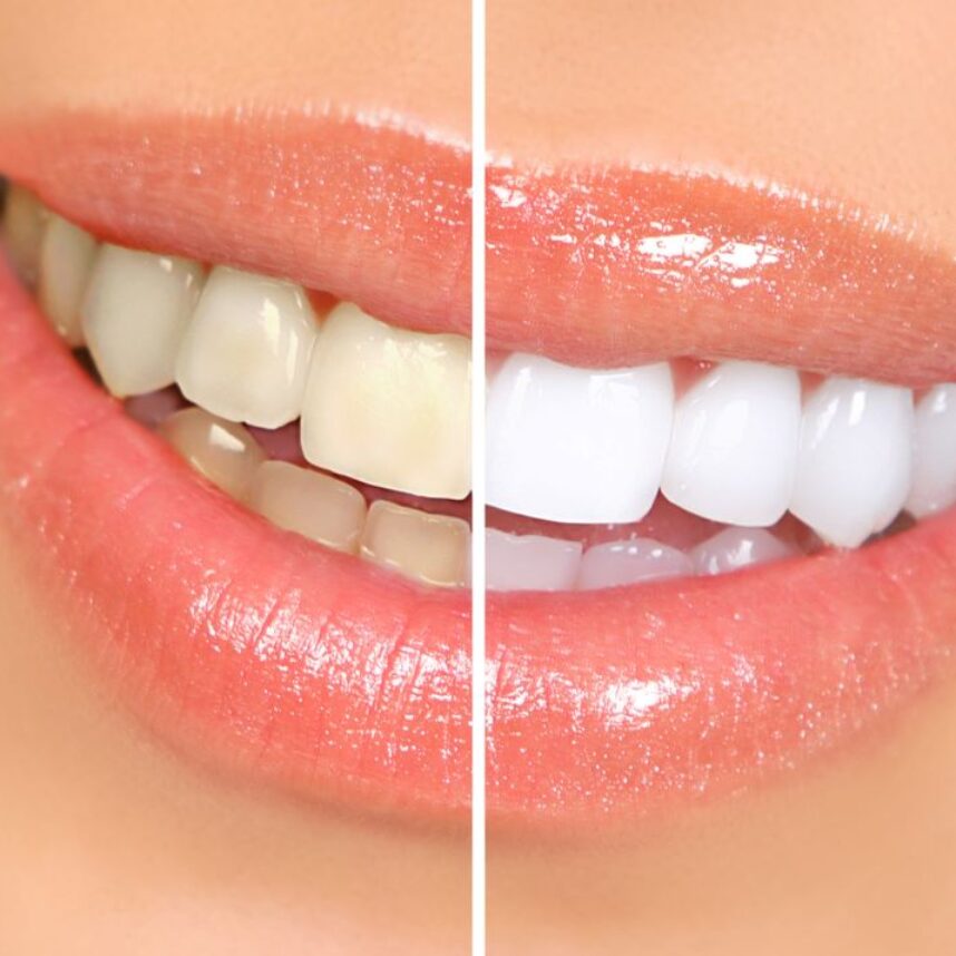 Contre-indications au blanchiment dentaire : Est-ce vrai? Contre-indications au blanchiment dentaire : Est-ce vrai?