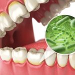 mauvaise-hygiene-dentaire-consequences
