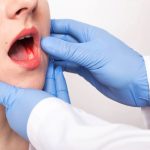 cancer-bouche-symptomes-prevention-traitements