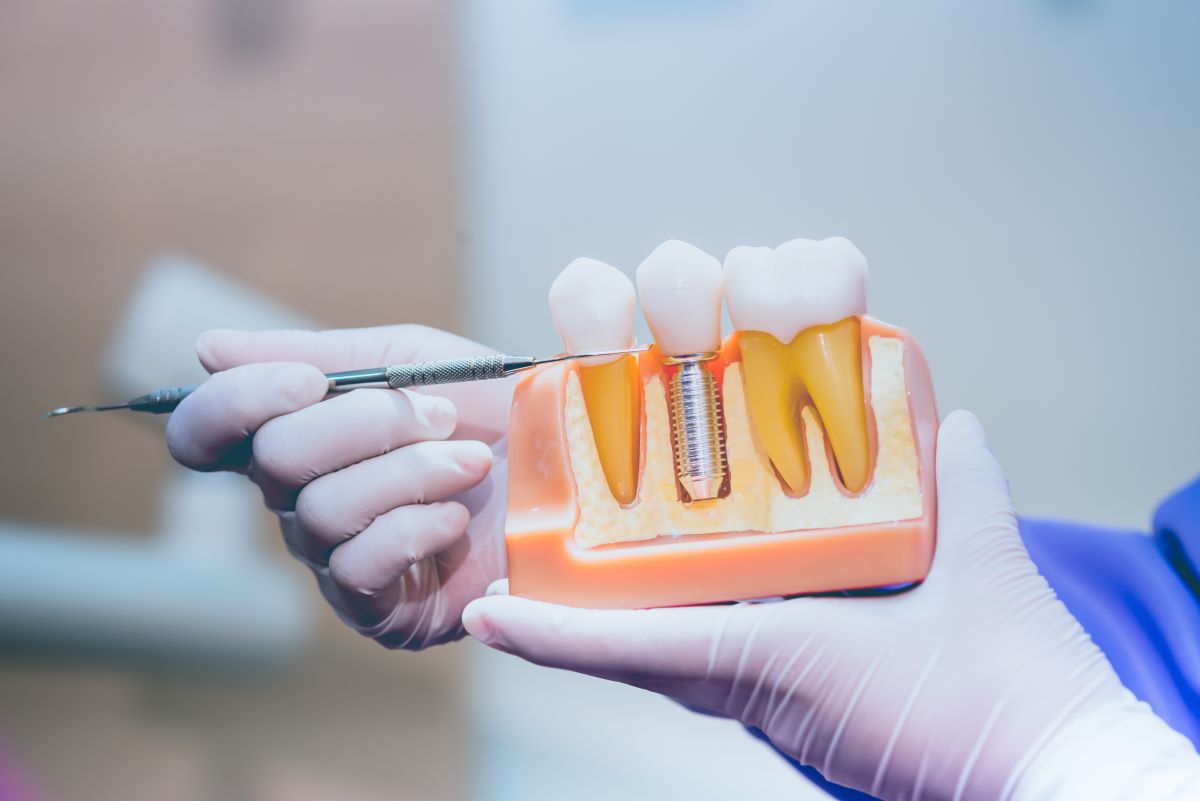 Pose d'un implant dentaire : tapes cls de la procdure