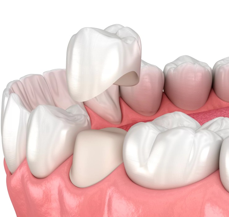 dentiste couronne montréal