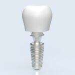 prix implant dentaire