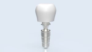 prix implant dentaire