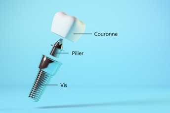 composition implant dentaire