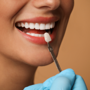 Restauration dentaire - facettes