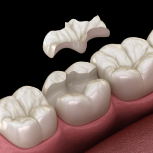 Restauration dentaire - incrustation